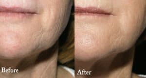 Skinfinity: Fractional Radio Frequency for skin tightening, scars and sun damage